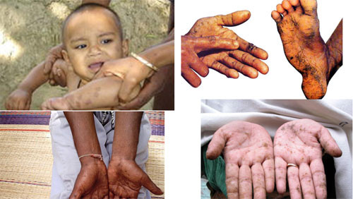 Bệnh ngoài da là một trong những hậu quả ô nhiễm nguồn nước