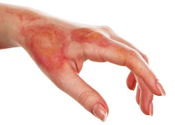Phenol là một hóa chất có độc tính cao, có thể gây bỏng nặng nếu rơi vào da
