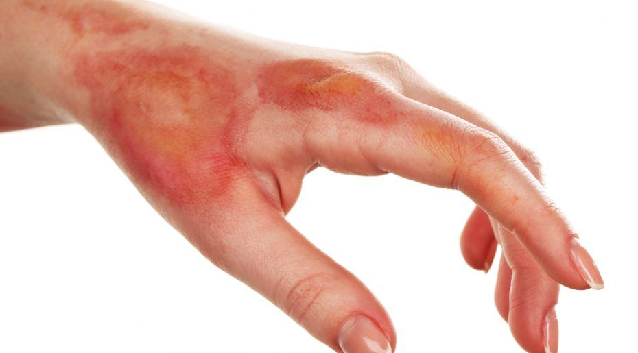 Natri sunfua có thể gây bỏng da khi tiếp xúc